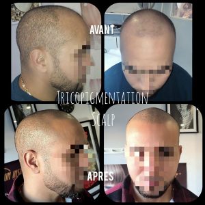 Tricopigmentation scalp