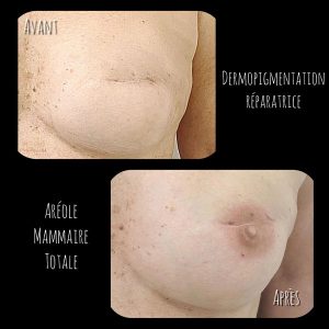 Dermopigmentation aréole mammaire