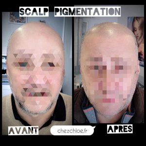 Scalp pigmentation
