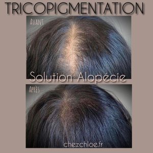 Tricopigmentation