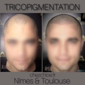 Tricopigmentation